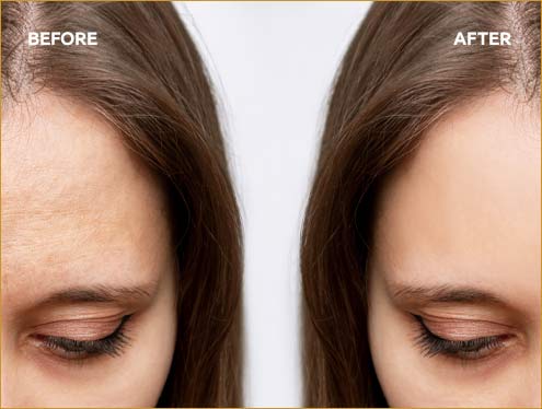 Anti-Wrinkle Injection Before & After